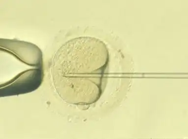 Microiniezione spermatica (ICSI)